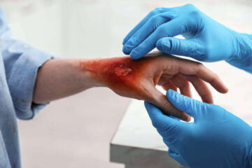 Doctor treating burn injury in the hands.